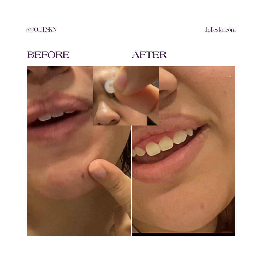 36 Acne Patches Day/Night Time