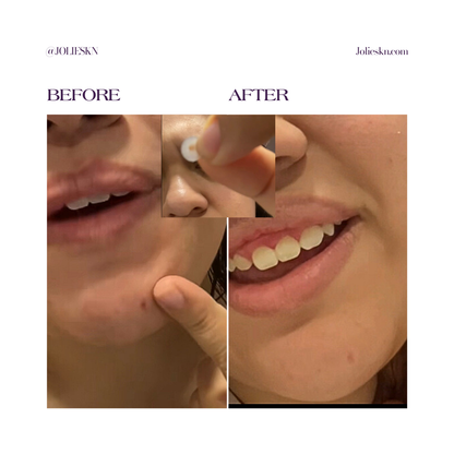 36 Acne Patches Day/Night Time