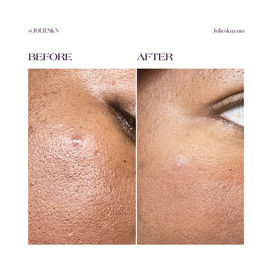 36 Acne Patches Day/Night Time