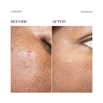 36 Acne Patches Day/Night Time
